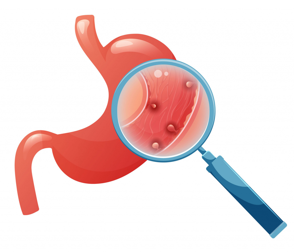 Полипы в желудке схематично