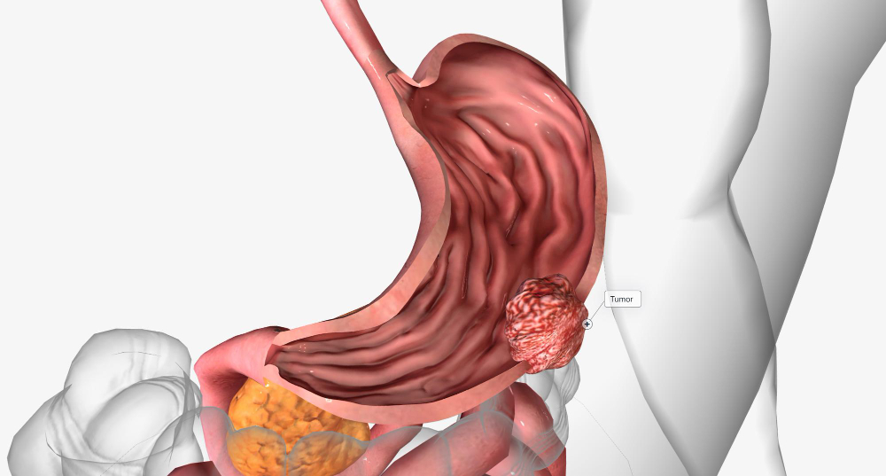 Рак желудка