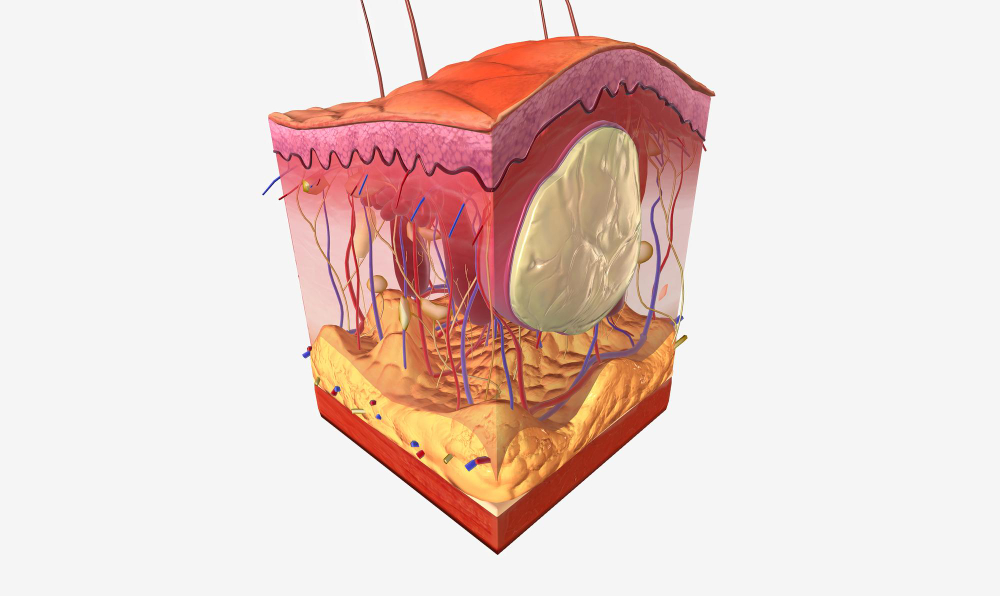 Атерома схематично