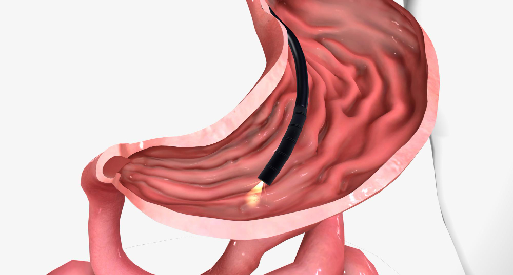 Эндоскоп в желудке схематично