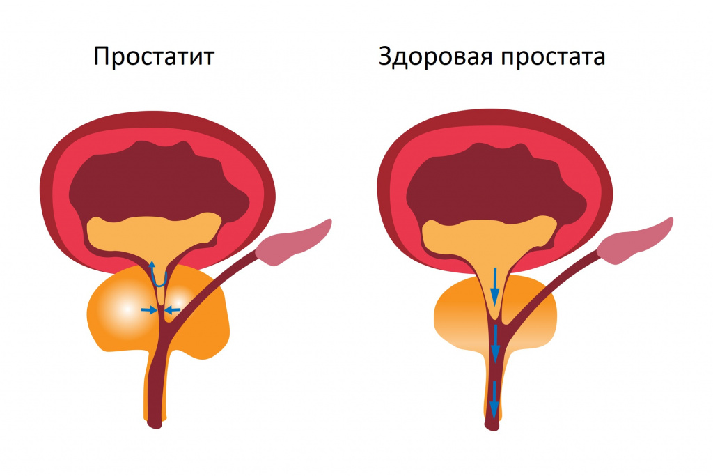 Простатит схема