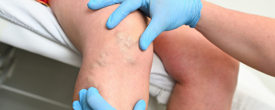 Когда нужно обращаться к флебологу