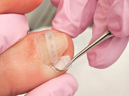 лечение ногтевой пластины