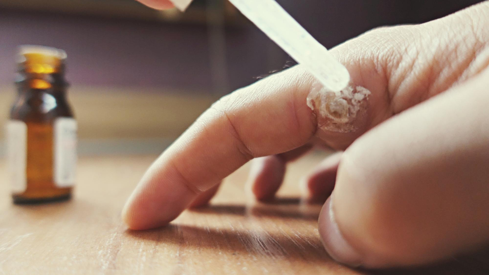 Лечение панариция