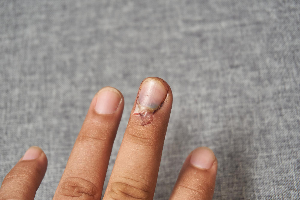 панариций пальцев руки