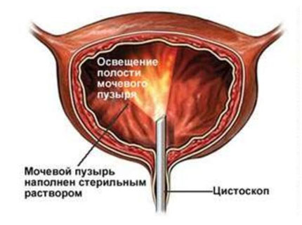 процесс цистоскопии